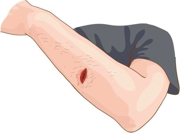 ‘Cep’ten ameliyat sonrası enfeksiyon takibi