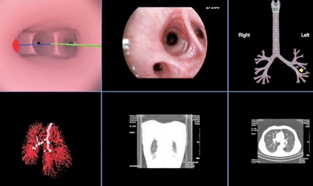 Akciğer navigasyonuyla kansere nokta atışı